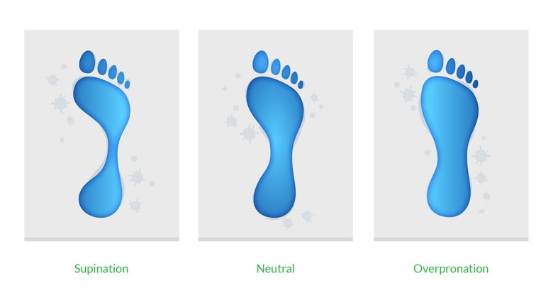 Supination of Foot and Oversupination